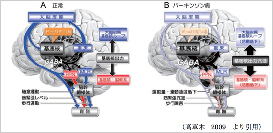 パーキンソン病　高草木