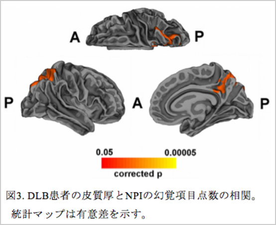 レビー小体型認知症、脳神経科学